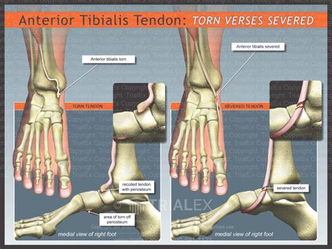Anterior Tibialis Tendon Torn Versus Severed Trial Exhibits In