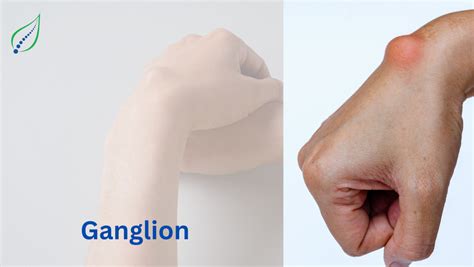 Ganglion Cysts Causes Symptoms And Treatment Options Best Back Pain Slip Disc Knee