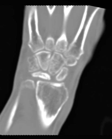 Fracture With Avascular Necrosis Avn Lunate Musculoskeletal Case