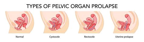 Tipos De Prolapsos De órgãos Pélvicos No Sistema Reprodutor Feminino