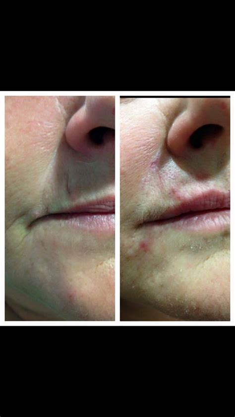 Before And After 2ml Of Filler Into Nasolabial Perioral And Marionette
