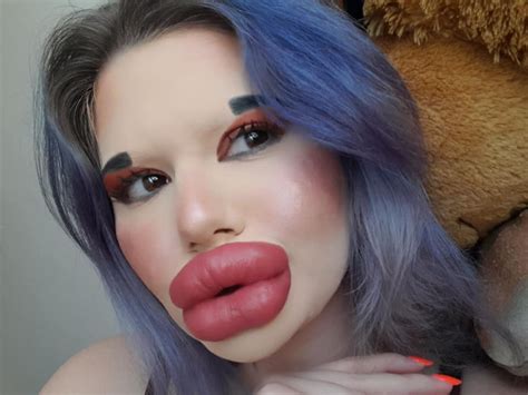 Bulgarian Woman With ‘biggest Lips In The World To Inject Lips For 27th Time This Christmas