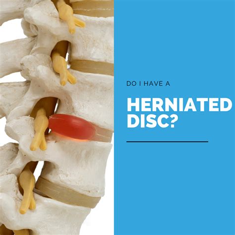 Do I Have A Herniated Disc New Jersey Comprehensive Spine Care