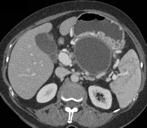 Pancreatic Pseudocyst Occludes The Splenic Vein With Extensive