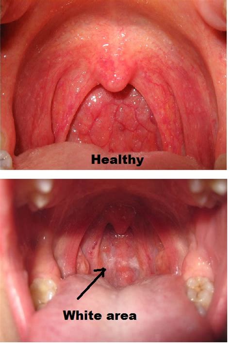 What Cause The White Spot Area On Throat
