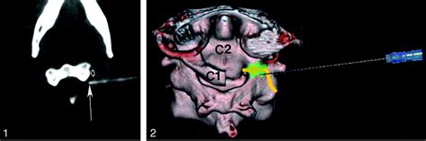 Refractory Occipital Neuralgia Preoperative Assessment With Ct Guided