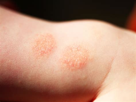 Can Discoid Eczema Be Caused By Stress Balmonds