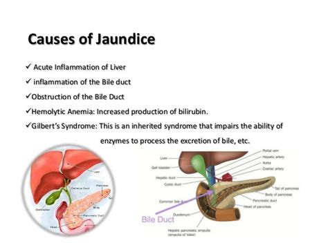 Causes And Treatment Methods For Jaundice