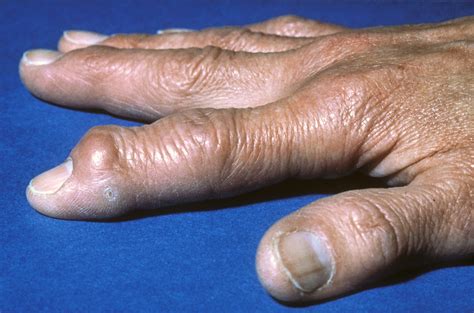 Low Dose Radiotherapy May Reduce Pain In Finger Osteoarthritis