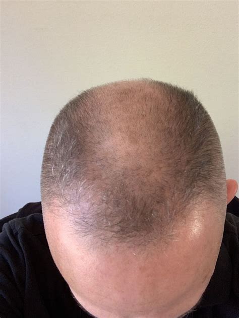 Landing Strip Flat Top Haircut Balding Stripping Hair Cuts Quick