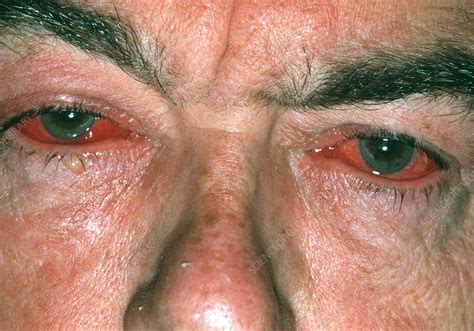 Viral Conjunctivitis Stock Image M1550440 Science Photo Library