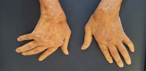 Rheumatoid Arthritis With Ulnar Deviation Of The Metacarpal Phalangeal