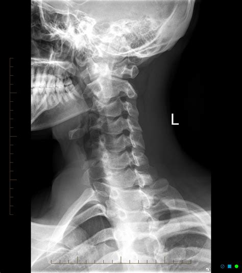 Normal Cervical Spine Buyxraysonline