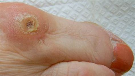 Foot Corn Causes Treatment And More