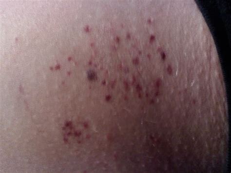 Little Red Blood Spots Under Skin On How To Get Rid Of