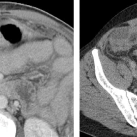 Axial Contrast Enhanced Computed Tomography Images Show Diffuse