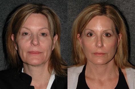 Deep Plane Facelift Before And After Dr Andrew Jacono Facial
