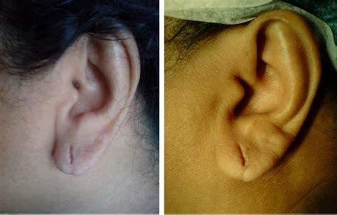 Split Ear Lobe Ear Lobe Repair In Trivandrum Kerala Dr Paulose