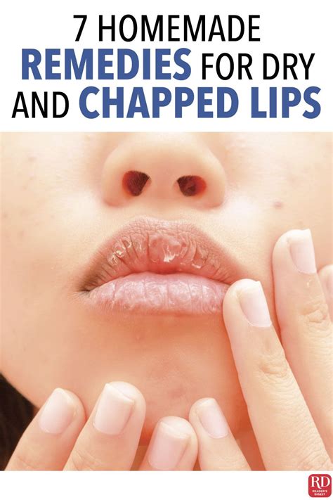 7 Homemade Remedies For Dry And Chapped Lips Dry Lips Remedy Chapped Lips Remedy Chapped Lips
