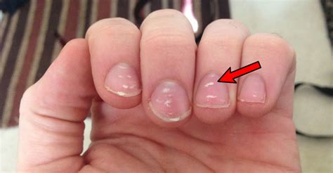 Done immediately while you are at a part.: If You See These White Spots on Your Nails, You Should See ...