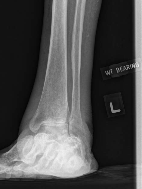 Ankle Weight Bearing Mortise View Radiology Reference Article