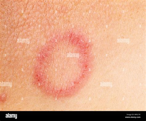 Ringworm Is A Clinical Condition Caused By Fungal Infection Of The