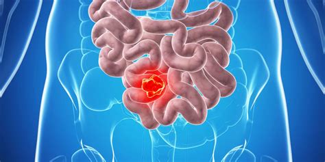The transverse colon crosses the abdominal cavity from right to left below the stomach and then bends downward. Bowel cancer (colon cancer): causes, symptoms, diagnosis