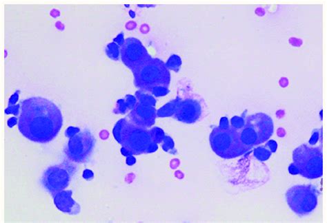 Cytological Examination Of The Pleural Fluid Showing Clusters Of