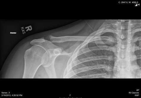 Distal Clavicle Osteolysis Symptoms Diagnosis And Treatment Bone And