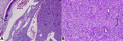 Cureus Aneurysmal Bone Cyst Of The Sphenoid Body Mimicking