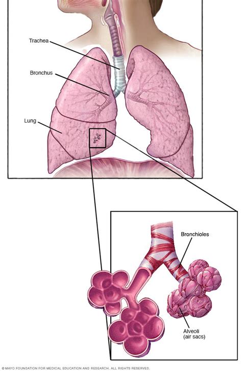 Possible causes, signs and symptoms, standard treatment options and means of care and support. Bronchioles and alveoli in the lungs - Mayo Clinic