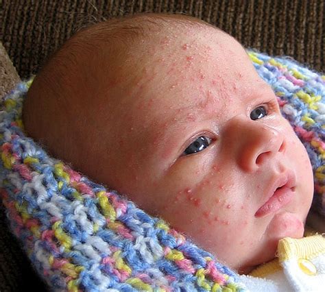 Why Do Babies Get Baby Acne Preemie Twins Baby Blog