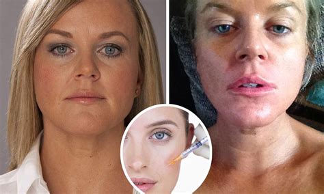 Cosmetic Fillers Can Destroy Your Looks The Truth Behind Botox Daily Mail Online