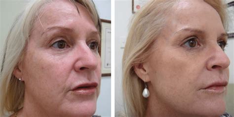 Clearlift™ The Lunchtime Facelift Health And Aesthetics