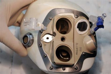 Worlds First Artificial Heart Patient “doing Well” Tootlafrance