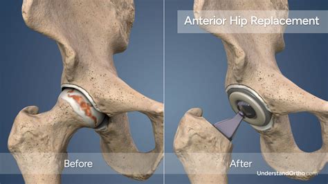 Hip Replacement Anterior Understandortho™