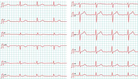 This tutorial will demonstrate the lead placement for the 12 lead ecg of the. Was ist ein EKG? | Herzlexikon | BlutdruckDaten