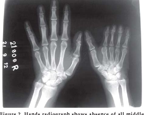 Figure 2 From Polands Syndrome With Unusual Hand And Chest Anomalies