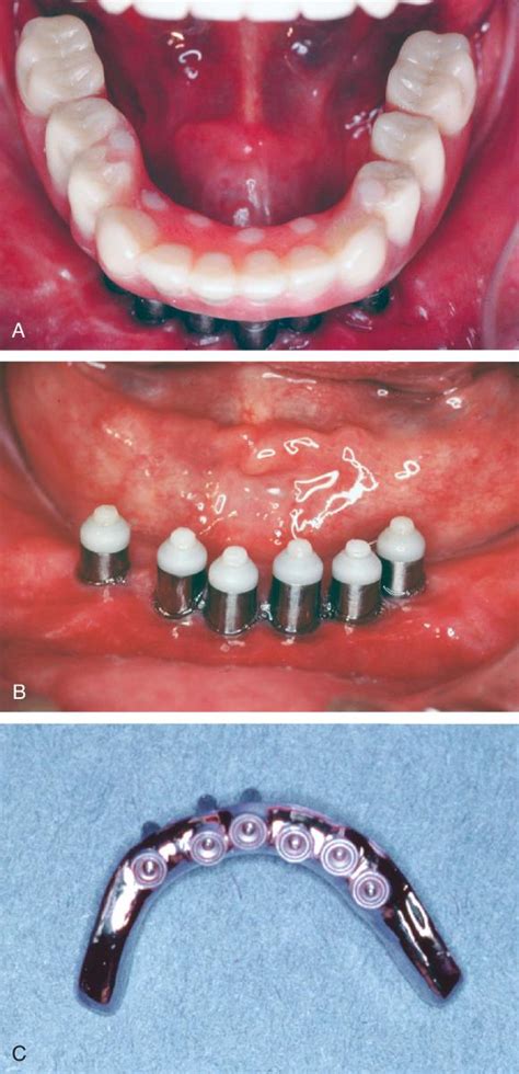 Dental Implants Pocket Dentistry
