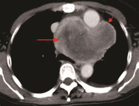 Contrast Enhanced Ct Detected A Large Wel Defined Lobulated Mass