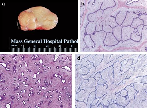 Gross And Histologic Features Of Fibroadenoma A Well Circumscribed