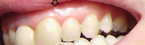 Hard Lump On Lower Gum What Doctors Want You To Know
