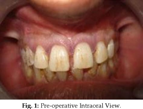 Figure 1 From Management Of A Dentigerous Cyst Associated With Inverted