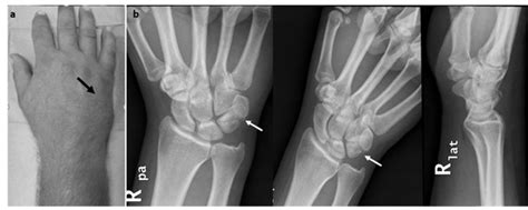 Intra Articular Fracture Of The Distal Part Of The