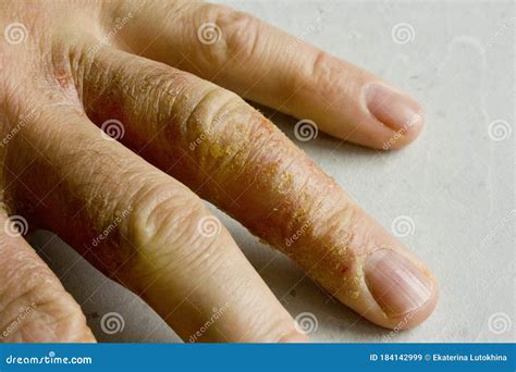 Cierre De La Dermatitis Eczema En Manos Y Dedos Del Hombre Descamación
