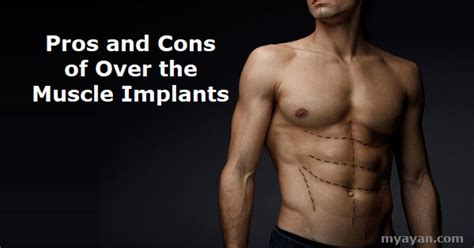 Pros And Cons Of Over The Muscle Implants Benefits