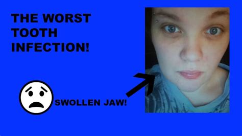 Swollen Jaw Tooth Pain Update Youtube