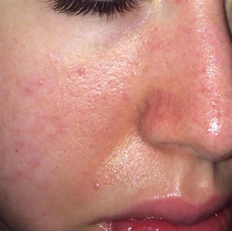Please Help Me Diagnose My Skin Redness Extreme Oiliness And