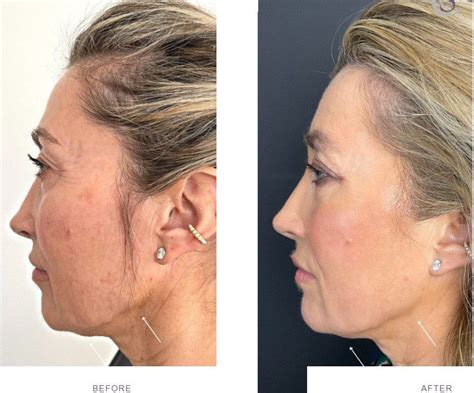 How To Get Rid Of Jowls Jowls Face Treatment London Buckinghamshire