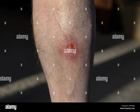 Infected Wound High Resolution Stock Photography And Images Alamy